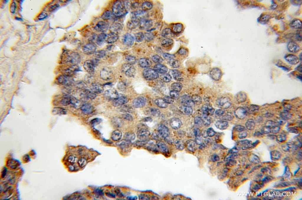 Immunohistochemistry (IHC) staining of human breast cancer tissue using Cathepsin K Polyclonal antibody (11239-1-AP)