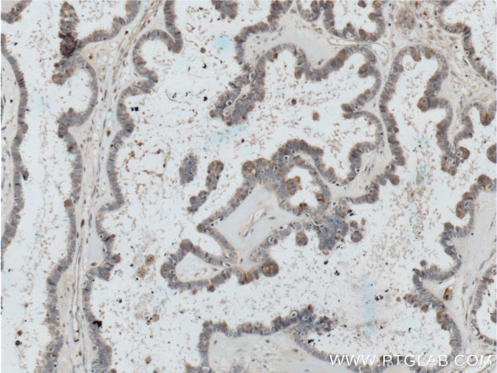 Immunohistochemistry (IHC) staining of human ovary tumor tissue using CTSO Polyclonal antibody (14296-1-AP)