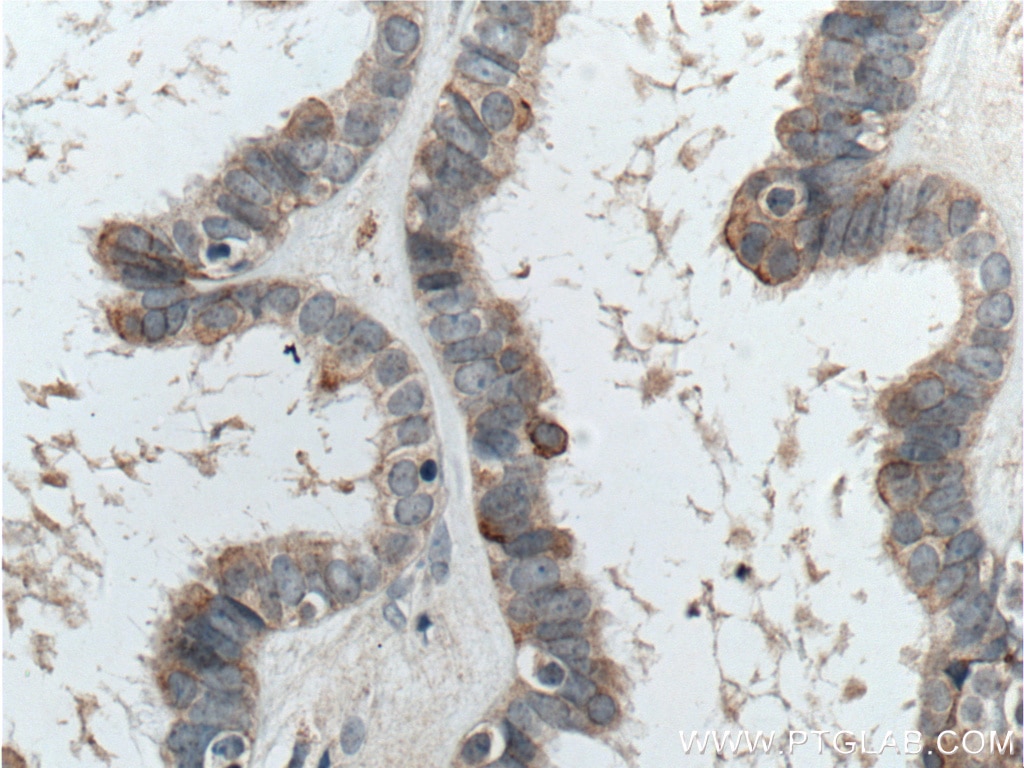 Immunohistochemistry (IHC) staining of human ovary tumor tissue using CTSO Polyclonal antibody (14296-1-AP)