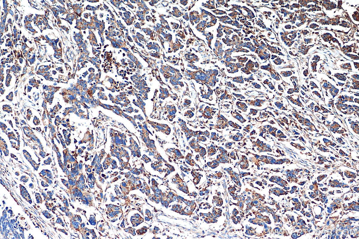 Immunohistochemistry (IHC) staining of human colon cancer tissue using CTSS Polyclonal antibody (27538-1-AP)