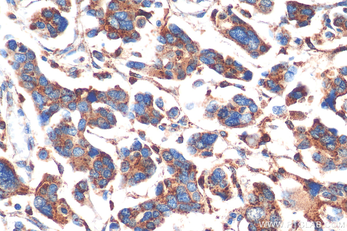 Immunohistochemistry (IHC) staining of human colon cancer tissue using CTSS Polyclonal antibody (27538-1-AP)