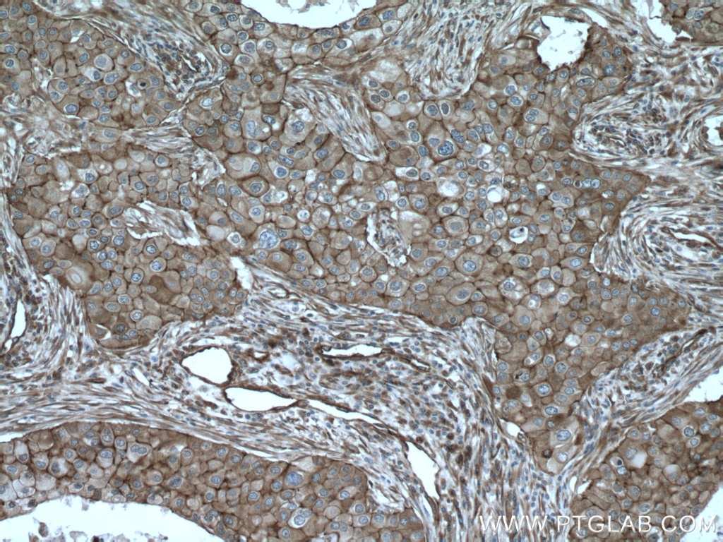 Immunohistochemistry (IHC) staining of human breast cancer tissue using Cortactin Polyclonal antibody (11381-1-AP)