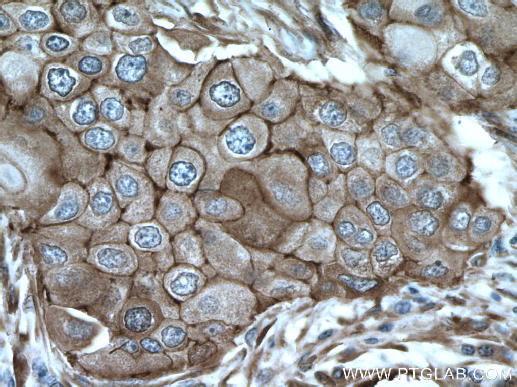 Immunohistochemistry (IHC) staining of human breast cancer tissue using Cortactin Polyclonal antibody (11381-1-AP)