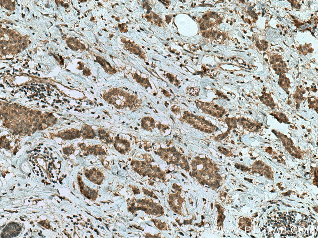 Immunohistochemistry (IHC) staining of human breast cancer tissue using CUEDC2 Polyclonal antibody (20123-1-AP)