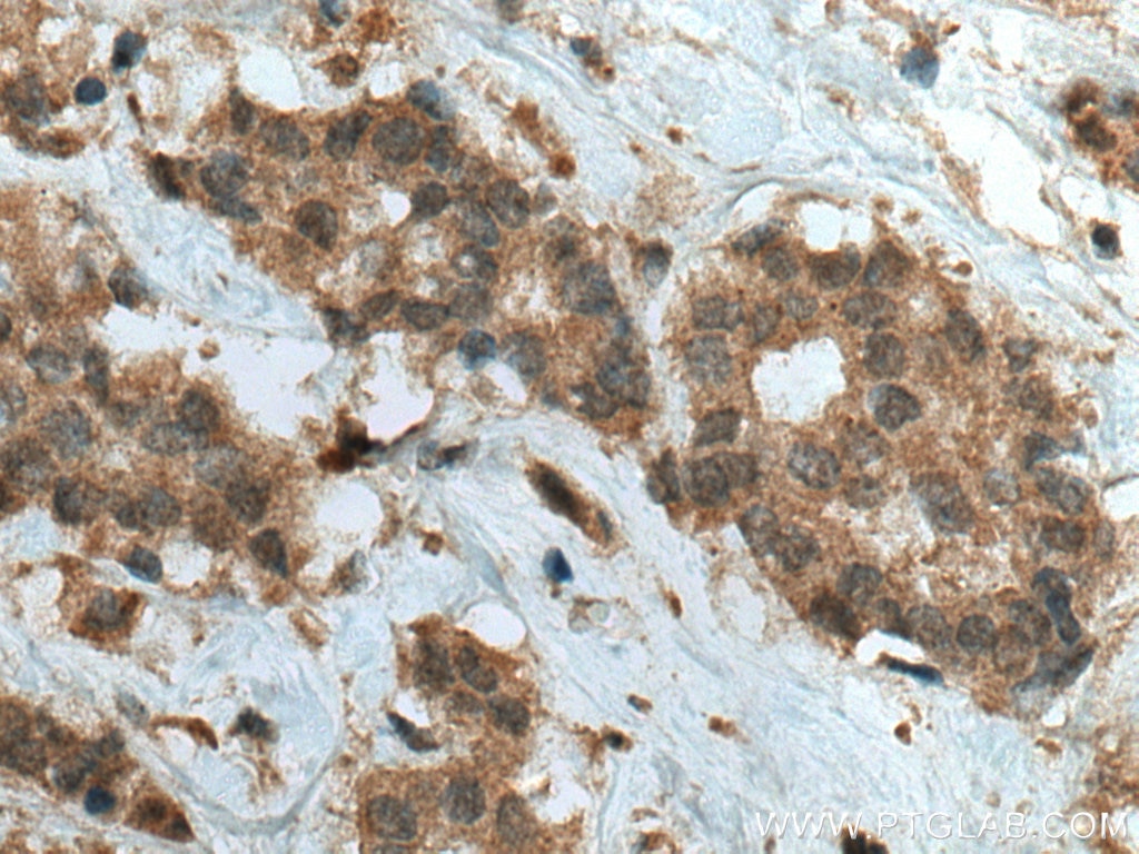 Immunohistochemistry (IHC) staining of human breast cancer tissue using CUEDC2 Polyclonal antibody (20123-1-AP)