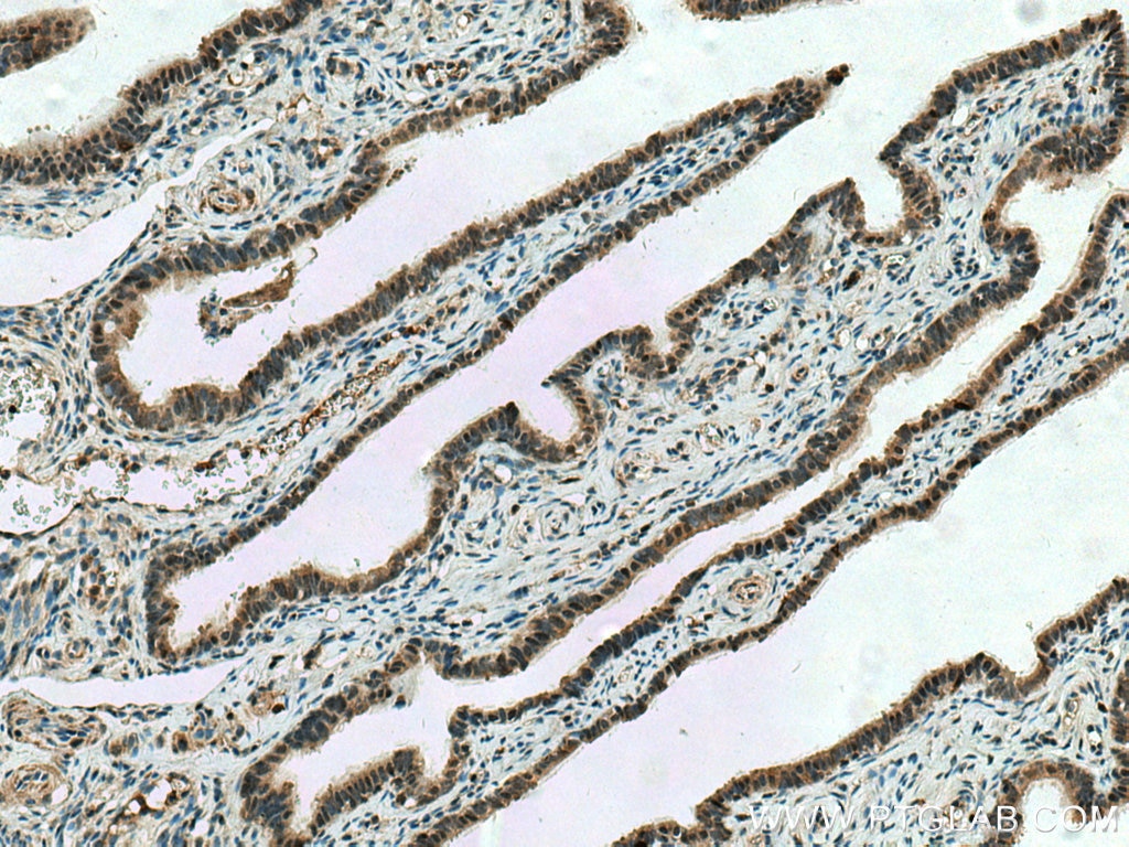 Immunohistochemistry (IHC) staining of human ovary tumor tissue using CUEDC2 Polyclonal antibody (20123-1-AP)
