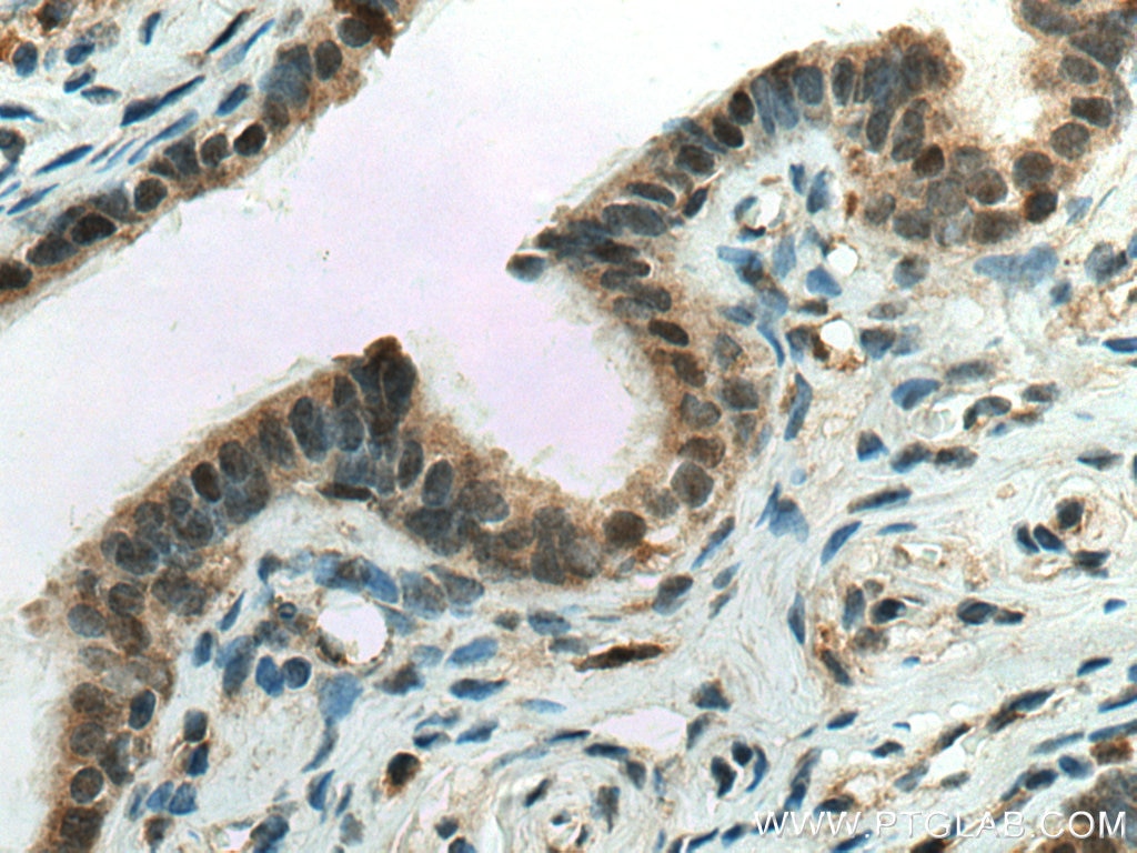 Immunohistochemistry (IHC) staining of human ovary tumor tissue using CUEDC2 Polyclonal antibody (20123-1-AP)