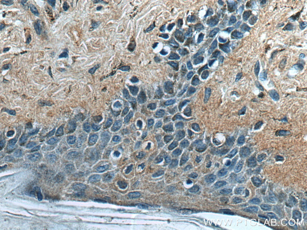 Immunohistochemistry (IHC) staining of human malignant melanoma tissue using CUEDC2 Polyclonal antibody (20123-1-AP)