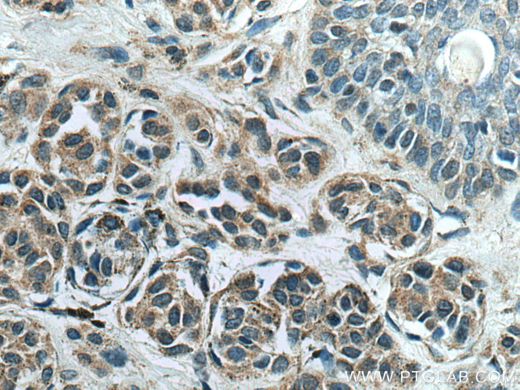 Immunohistochemistry (IHC) staining of human malignant melanoma tissue using CUEDC2 Polyclonal antibody (20123-1-AP)