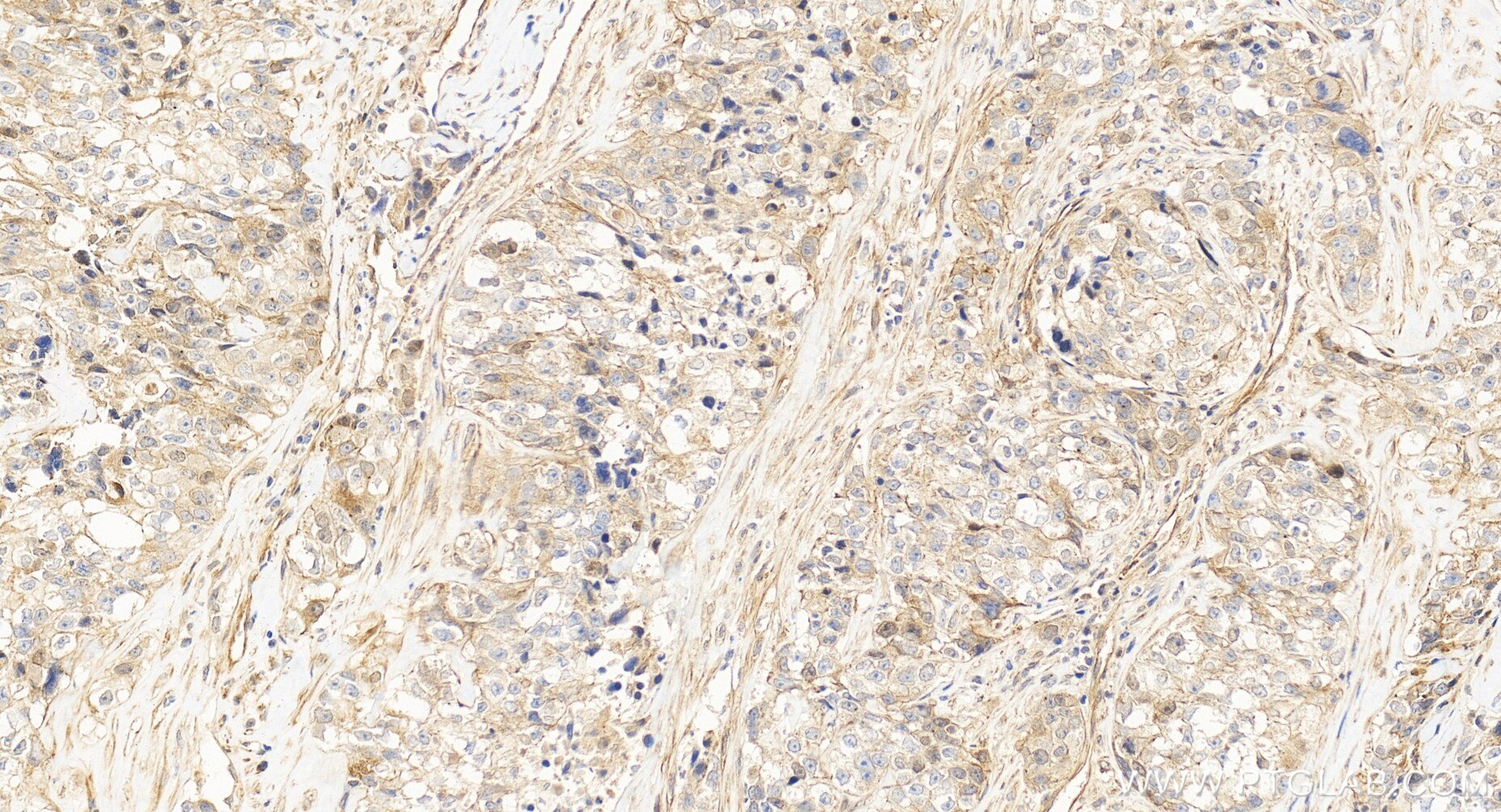 Immunohistochemical analysis of paraffin-embedded human ovary cancer tissue slide using 86610-2-RR (CUEDC2 antibody) at dilution of 1:200 (under 20x lens). Heat mediated antigen retrieval with Tris-EDTA buffer (pH 9.0). Immunohistochemistry (IHC) staining of human ovary cancer tissue using CUEDC2 Recombinant monoclonal antibody (86610-2-RR)