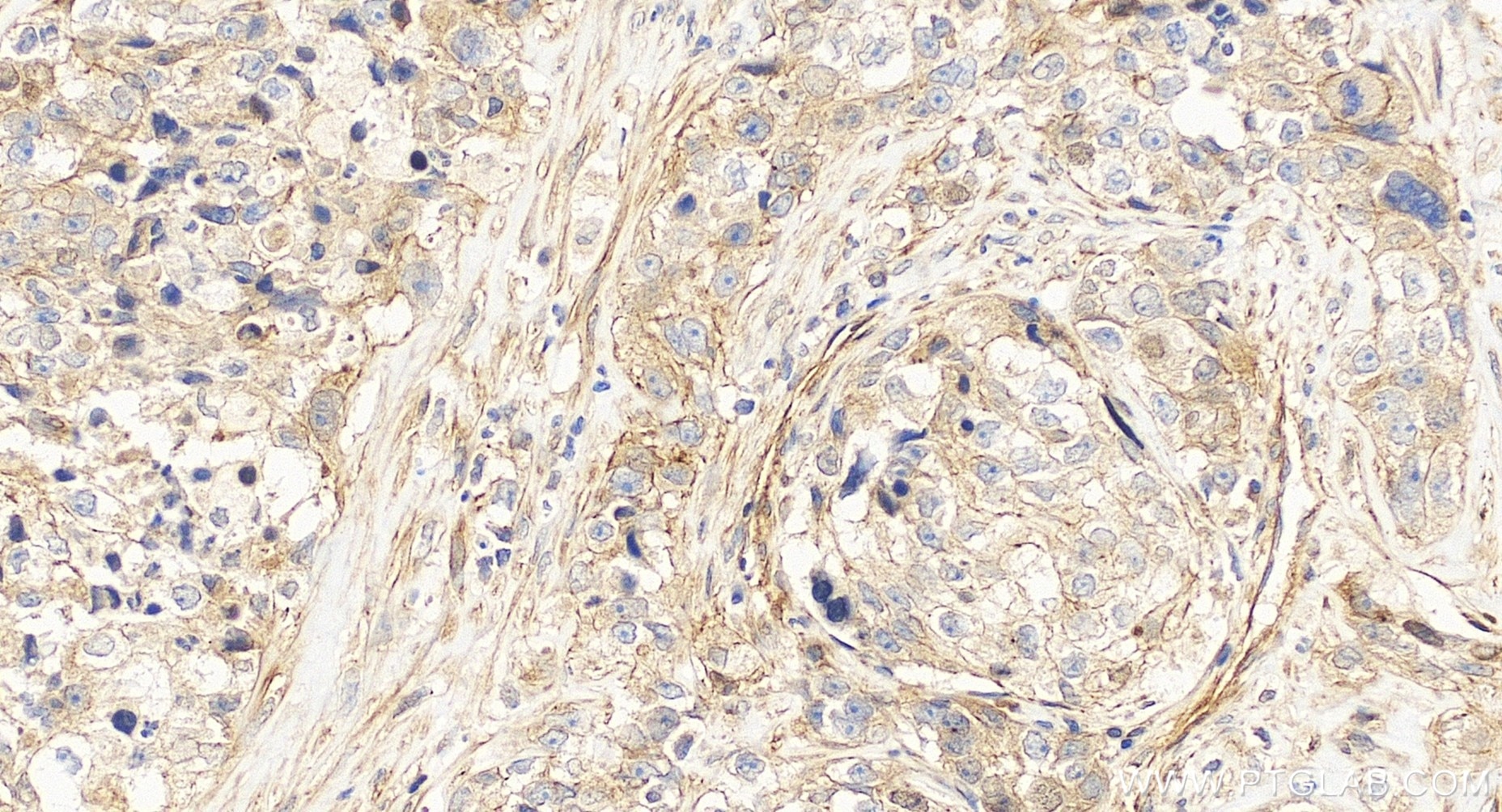 Immunohistochemical analysis of paraffin-embedded human ovary cancer tissue slide using 86610-2-RR (CUEDC2 antibody) at dilution of 1:200 (under 20x lens). Heat mediated antigen retrieval with Tris-EDTA buffer (pH 9.0). Immunohistochemistry (IHC) staining of human ovary cancer tissue using CUEDC2 Recombinant monoclonal antibody (86610-2-RR)
