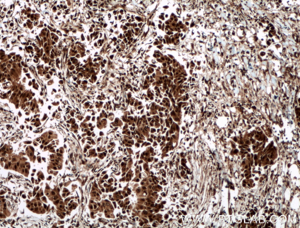 Immunohistochemistry (IHC) staining of human breast cancer tissue using CUGBP1 Polyclonal antibody (13002-1-AP)