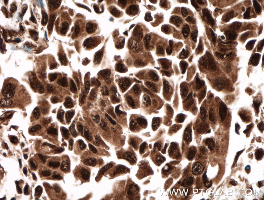 Immunohistochemistry (IHC) staining of human breast cancer tissue using CUGBP1 Polyclonal antibody (13002-1-AP)