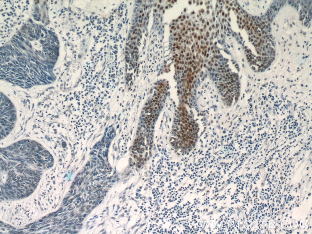 IHC staining of human skin cancer using 13002-1-AP
