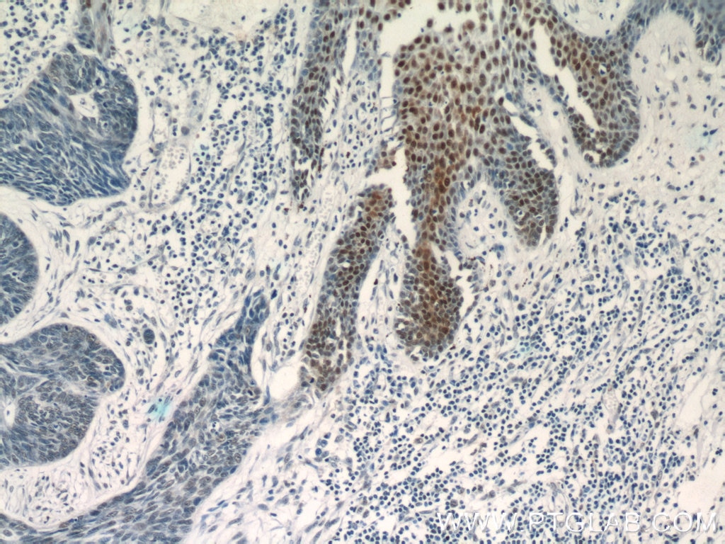 Immunohistochemistry (IHC) staining of human skin cancer tissue using CUGBP1 Polyclonal antibody (13002-1-AP)