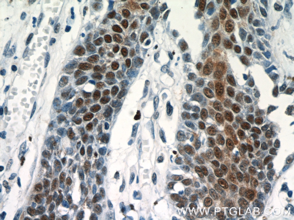 Immunohistochemistry (IHC) staining of human skin cancer tissue using CUGBP1 Polyclonal antibody (13002-1-AP)