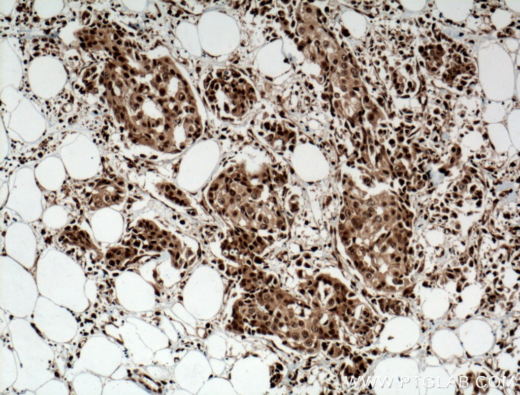 Immunohistochemistry (IHC) staining of human breast cancer tissue using CUGBP2 Polyclonal antibody (12921-1-AP)