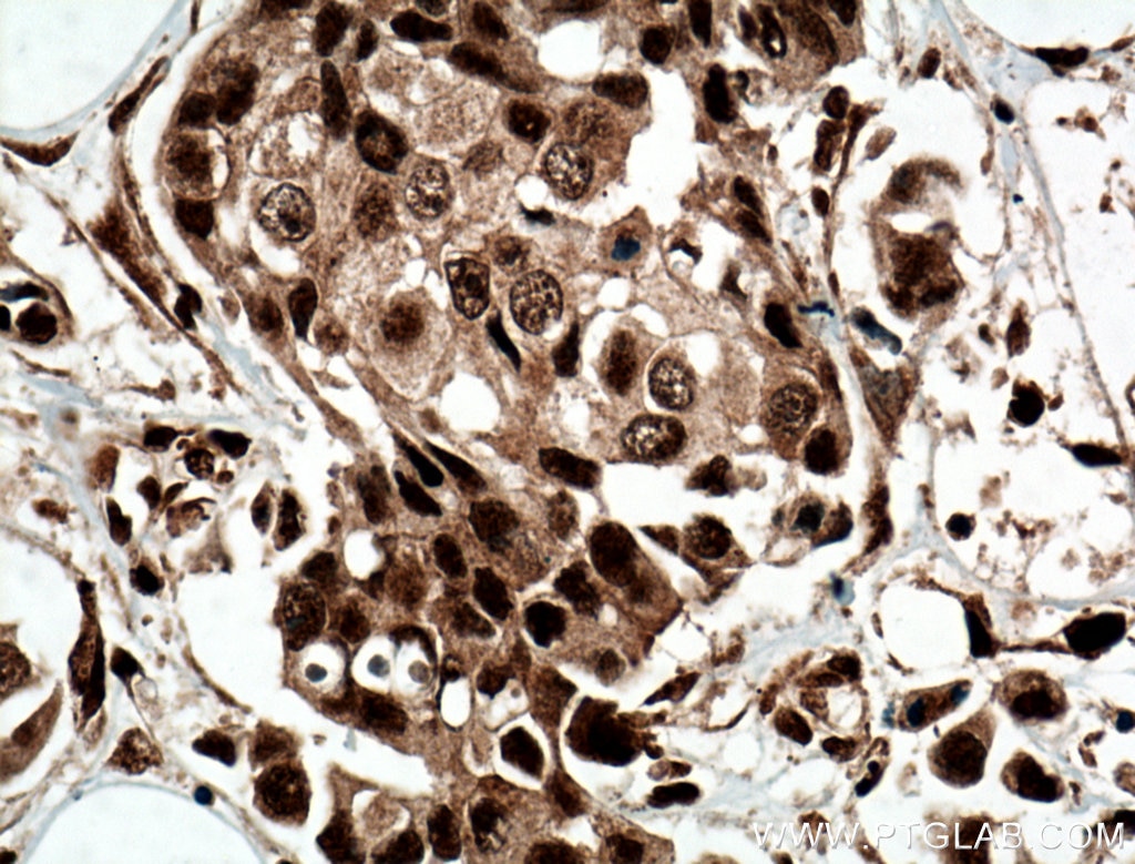 Immunohistochemistry (IHC) staining of human breast cancer tissue using CUGBP2 Polyclonal antibody (12921-1-AP)