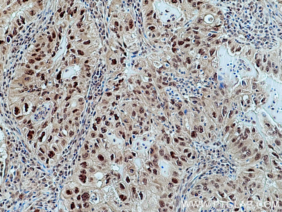 Immunohistochemistry (IHC) staining of human lung cancer tissue using CUL1 Polyclonal antibody (12895-1-AP)