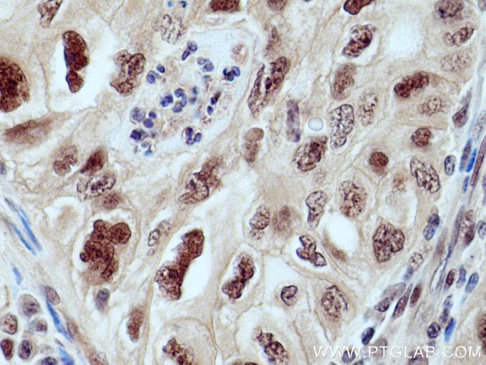 Immunohistochemistry (IHC) staining of human lung cancer tissue using CUL1 Polyclonal antibody (12895-1-AP)