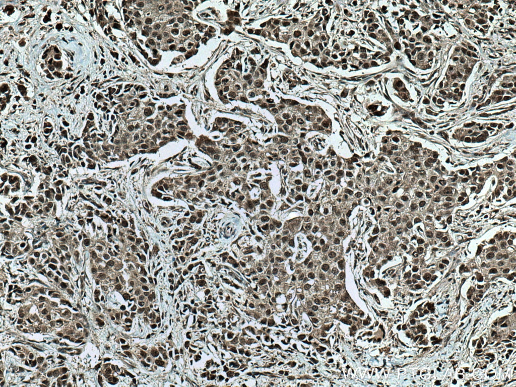 Immunohistochemistry (IHC) staining of human breast cancer tissue using CUL1 Polyclonal antibody (28404-1-AP)