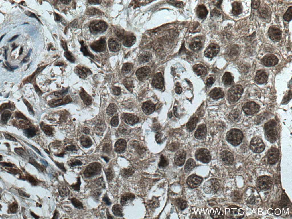 Immunohistochemistry (IHC) staining of human breast cancer tissue using CUL1 Polyclonal antibody (28404-1-AP)