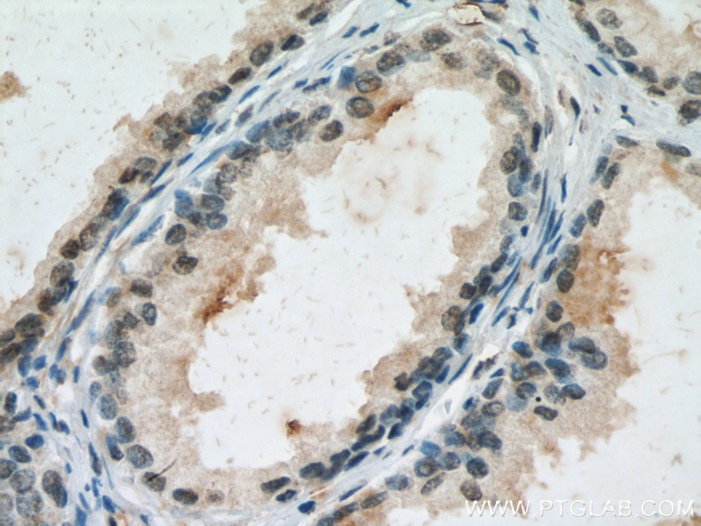 Immunohistochemistry (IHC) staining of human prostate cancer tissue using CUL1 Monoclonal antibody (66978-1-Ig)