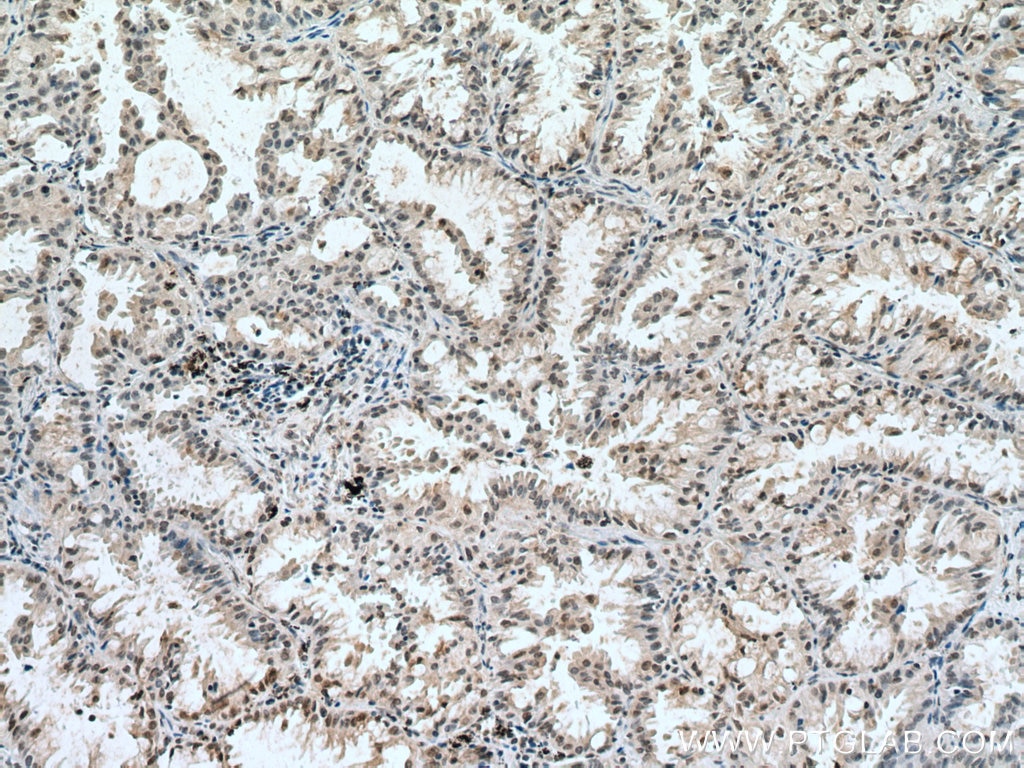 Immunohistochemistry (IHC) staining of human lung cancer tissue using CUL1 Monoclonal antibody (66978-1-Ig)