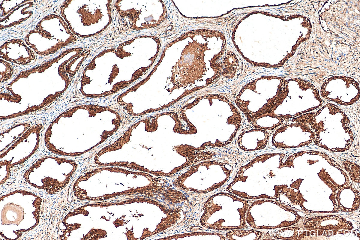 Immunohistochemistry (IHC) staining of human prostate cancer tissue using CUL2 Polyclonal antibody (10981-2-AP)