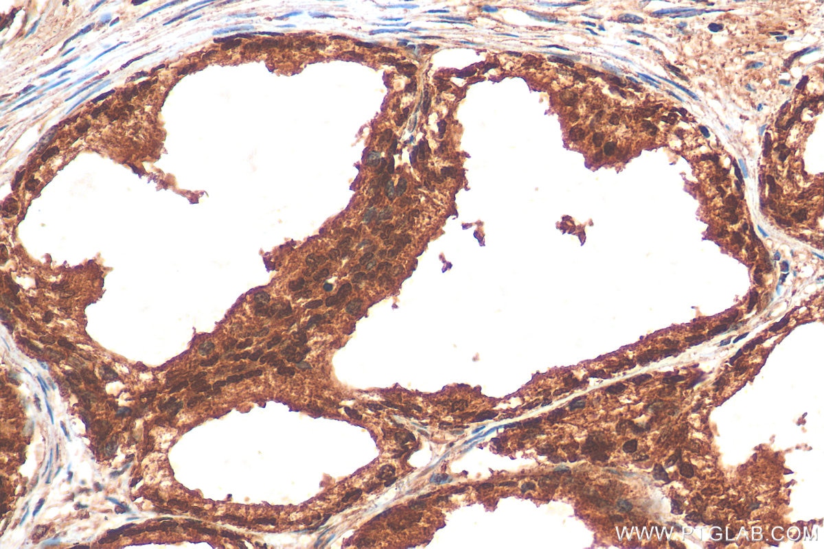 Immunohistochemistry (IHC) staining of human prostate cancer tissue using CUL2 Polyclonal antibody (10981-2-AP)