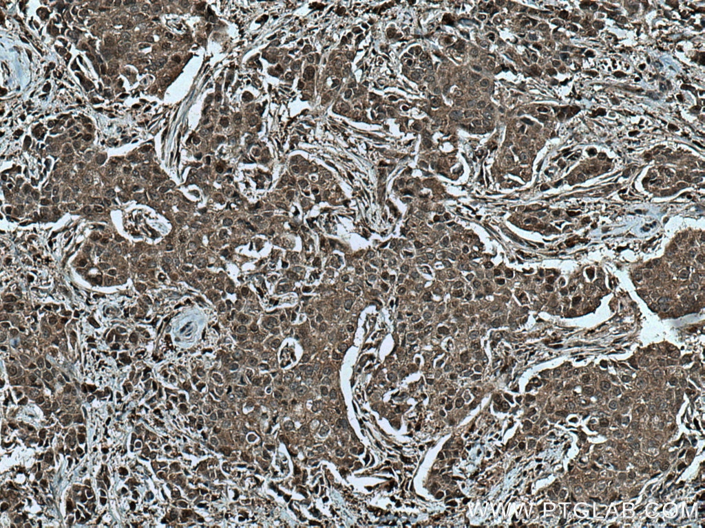 Immunohistochemistry (IHC) staining of human breast cancer tissue using CUL2 Monoclonal antibody (67175-1-Ig)