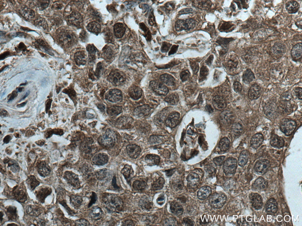 Immunohistochemistry (IHC) staining of human breast cancer tissue using CUL2 Monoclonal antibody (67175-1-Ig)