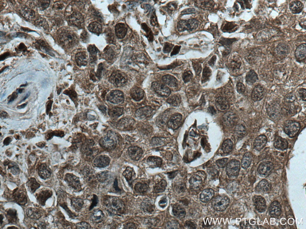 IHC staining of human breast cancer using 67175-1-Ig