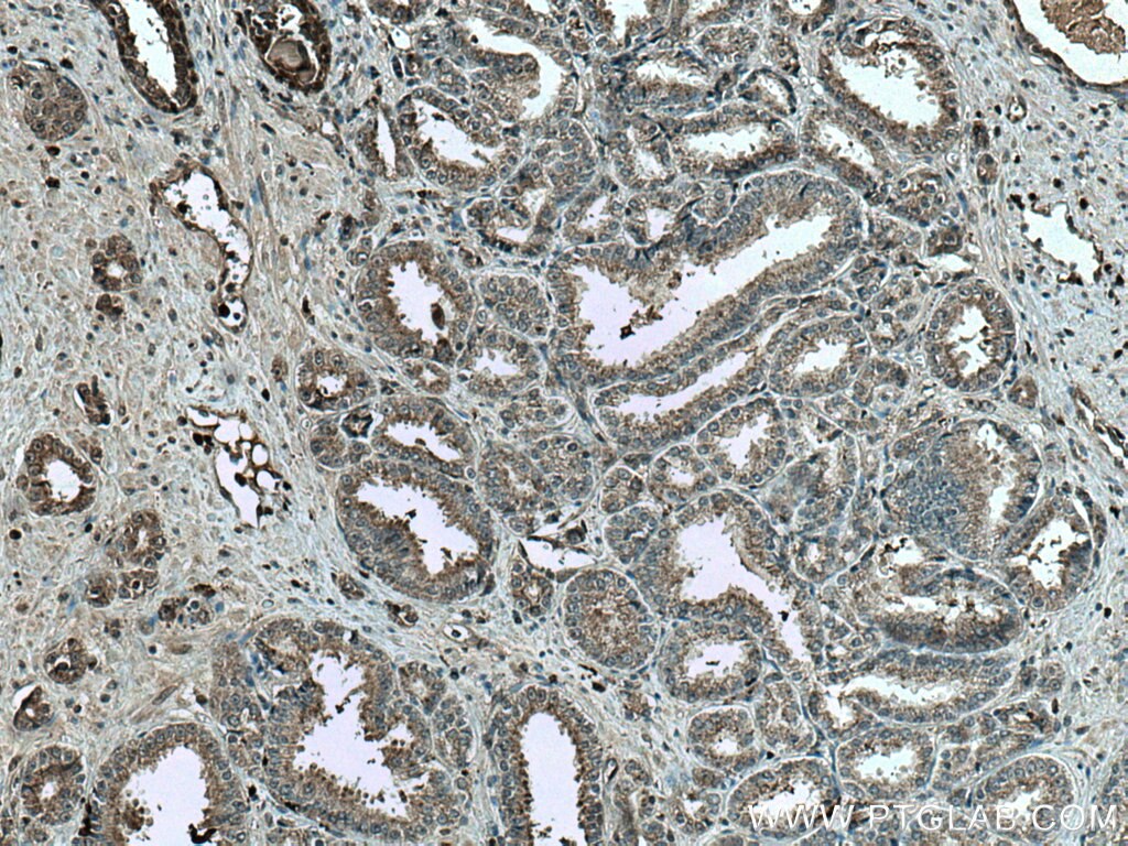 Immunohistochemistry (IHC) staining of human prostate cancer tissue using CUL2 Monoclonal antibody (67175-1-Ig)
