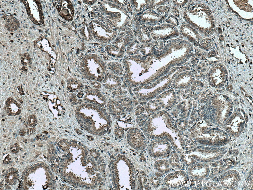 IHC staining of human prostate cancer using 67175-1-Ig