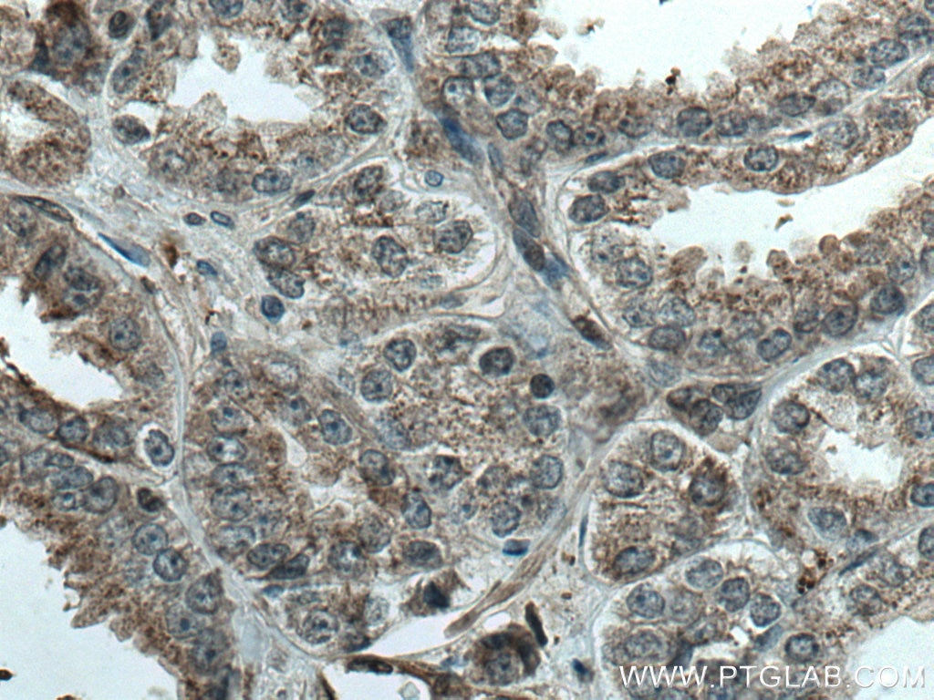 Immunohistochemistry (IHC) staining of human prostate cancer tissue using CUL2 Monoclonal antibody (67175-1-Ig)