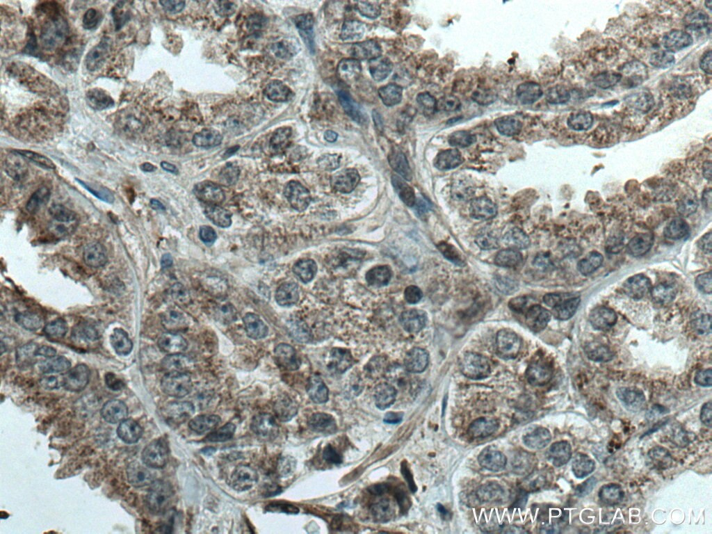 IHC staining of human prostate cancer using 67175-1-Ig