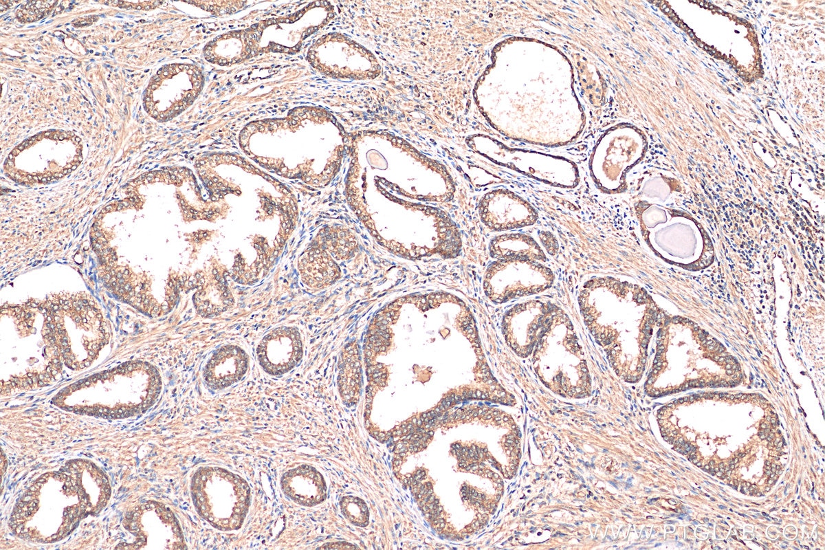 Immunohistochemistry (IHC) staining of human prostate cancer tissue using CUL3 Polyclonal antibody (11107-1-AP)
