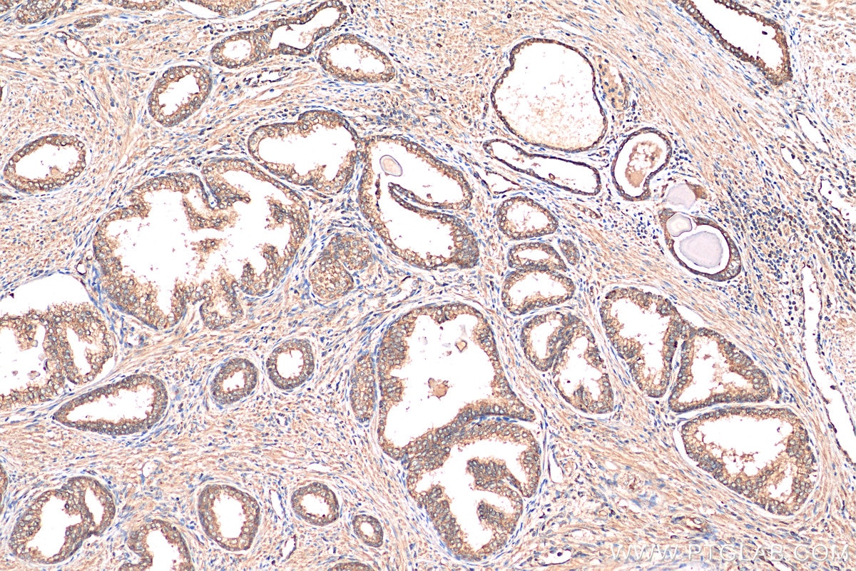 IHC staining of human prostate cancer using 11107-1-AP