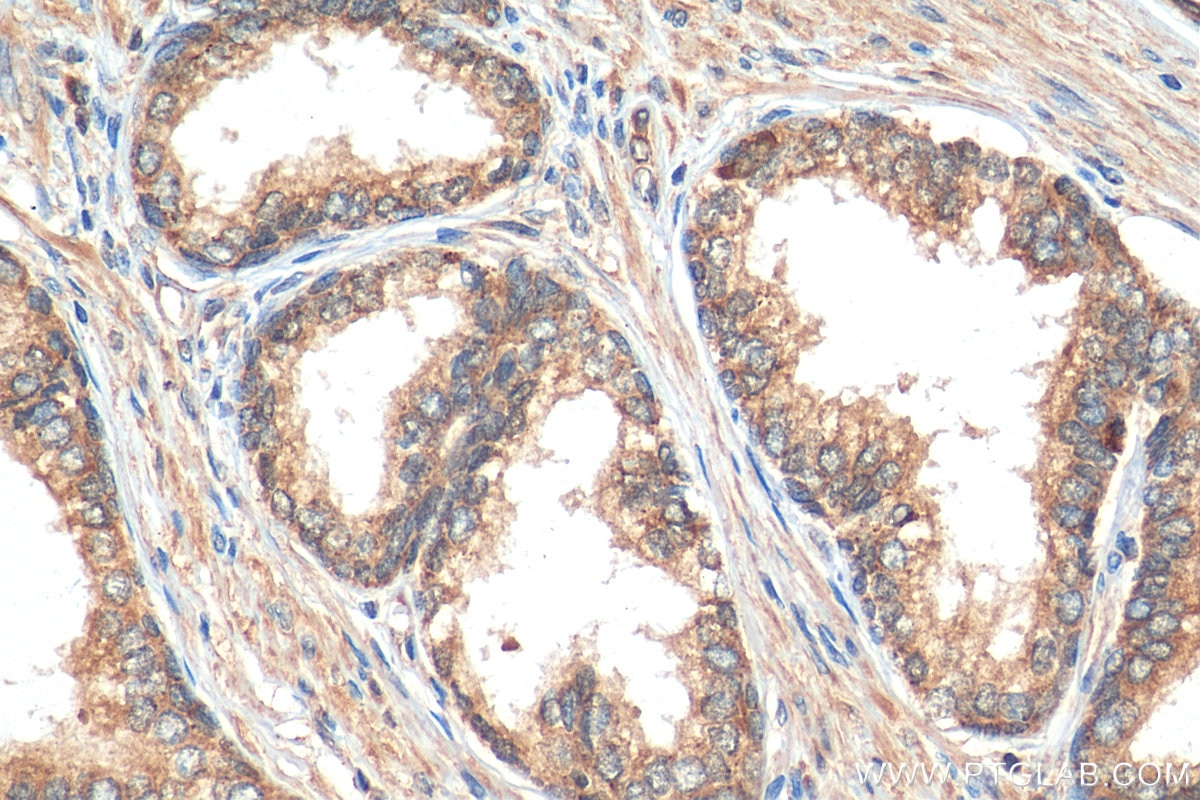 IHC staining of human prostate cancer using 11107-1-AP