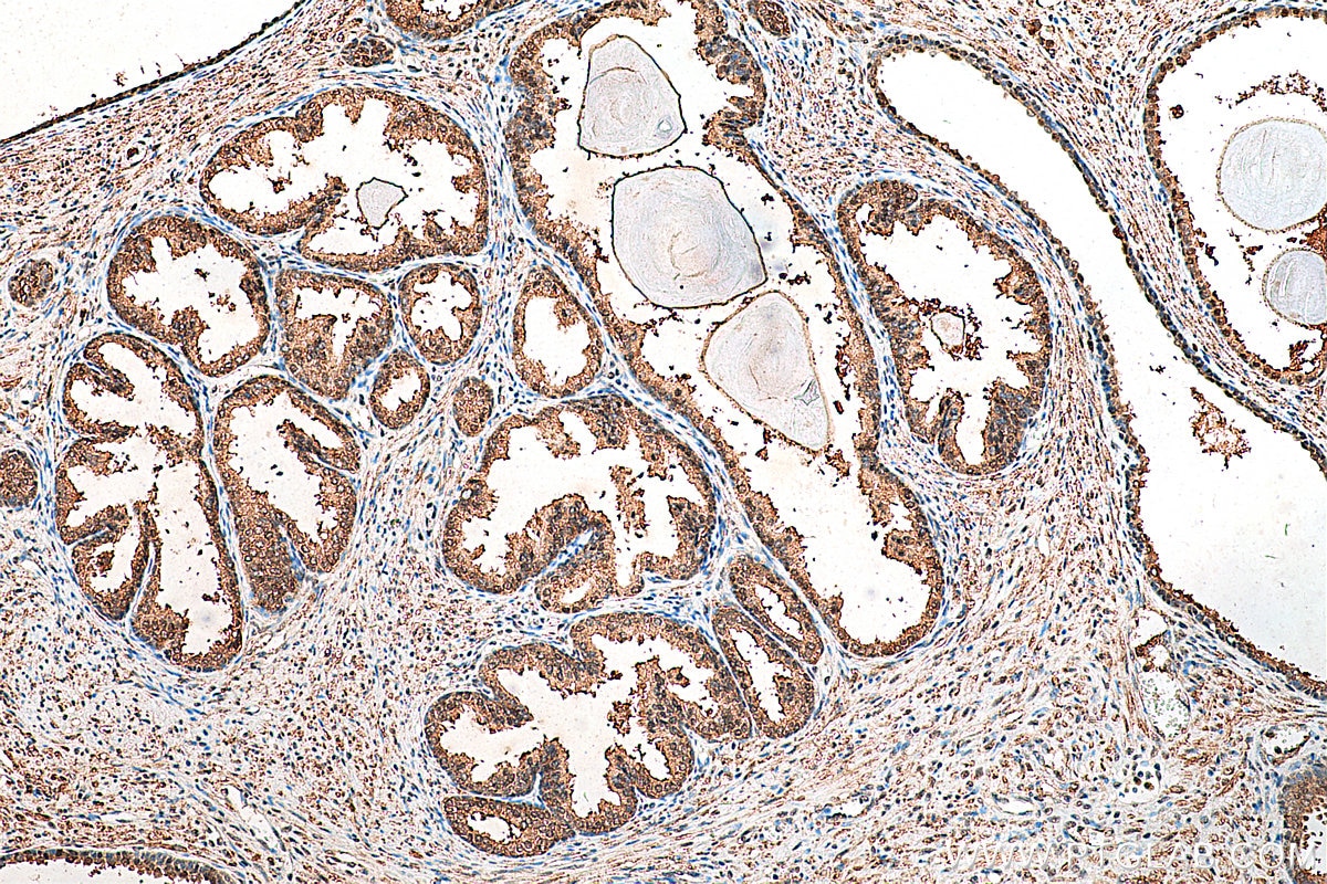 Immunohistochemistry (IHC) staining of human prostate cancer tissue using CUL3 Polyclonal antibody (28087-1-AP)