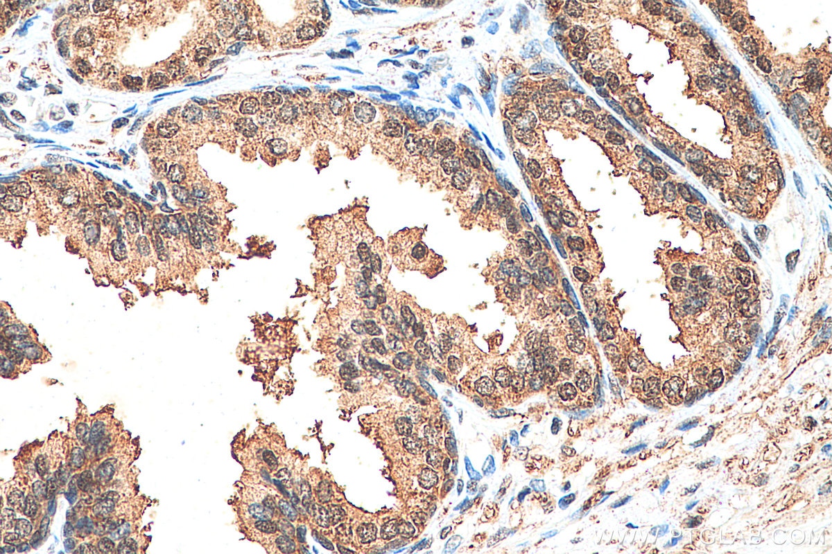 Immunohistochemistry (IHC) staining of human prostate cancer tissue using CUL3 Polyclonal antibody (28087-1-AP)