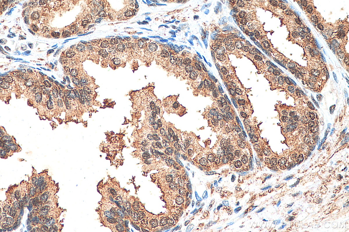 IHC staining of human prostate cancer using 28087-1-AP