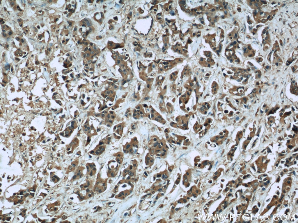 Immunohistochemistry (IHC) staining of human breast cancer tissue using CUL4A Monoclonal antibody (66038-1-Ig)