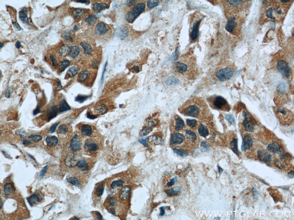 Immunohistochemistry (IHC) staining of human breast cancer tissue using CUL4A Monoclonal antibody (66038-1-Ig)