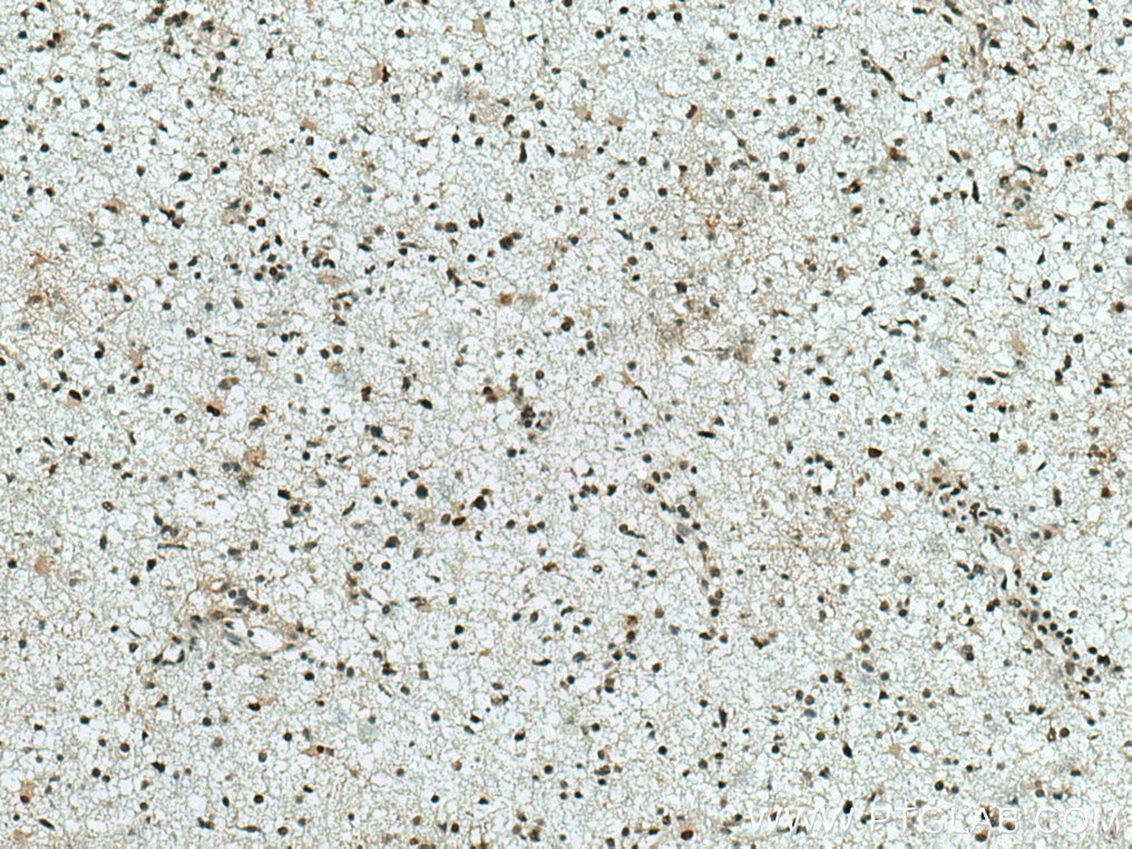 Immunohistochemistry (IHC) staining of human gliomas tissue using CUL4B Polyclonal antibody (20882-1-AP)