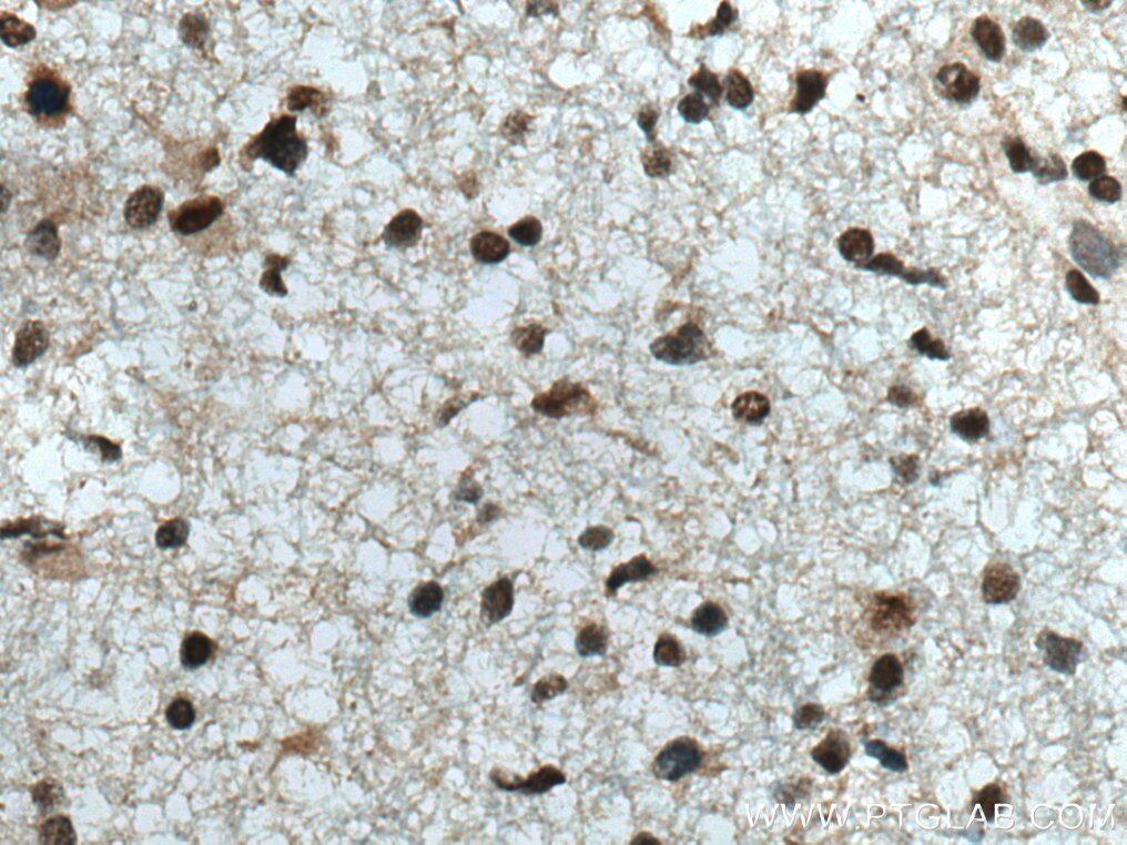 Immunohistochemistry (IHC) staining of human gliomas tissue using CUL4B Polyclonal antibody (20882-1-AP)