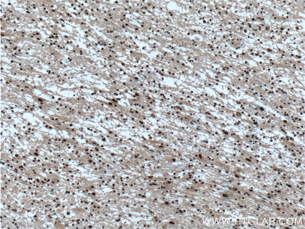 Immunohistochemistry (IHC) staining of human gliomas tissue using CUL4B Polyclonal antibody (20882-1-AP)
