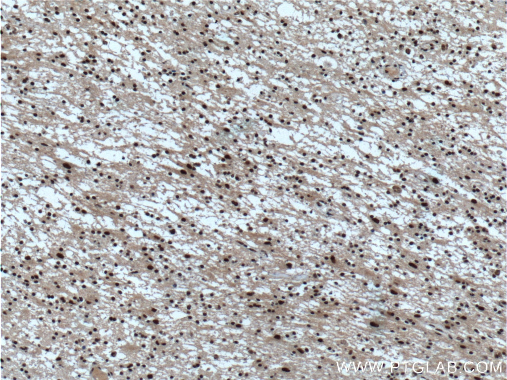 IHC staining of human gliomas using 20882-1-AP