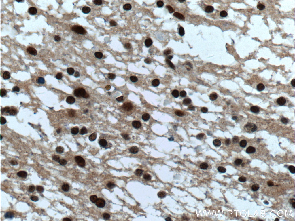 IHC staining of human gliomas using 20882-1-AP